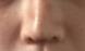 鼻子整形90天不管是從正面還是側面來看，面部形態都很精致