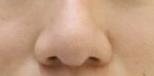 隆鼻術后有40多天，鼻子看上去特別的立體，恢復圖片分享一波