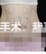 分享医美改善老大妈形象亲身体验案例 术后三个月看起来更加苗条