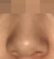 硅胶隆鼻案例，现在的小翘鼻太配我的五官了