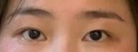分享雙眼皮手術親身體驗案例 術后三個月一雙漂亮的大眼睛呈現