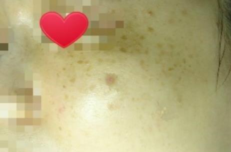 分享一個激光祛痘還有皮膚護理的例子，臭美臭美下