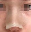 隆鼻手術40天后的效果，朋友都說我的鼻特別自然
