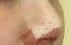 隆鼻案例：鼻子變立體之后面容也顯得精致，側面看很有曲線感