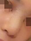 假體隆鼻真人案例：因為鼻子的改變，變得更加漂亮