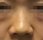 隆鼻手术后高清图片展示，现在整个鼻子都挺精致的