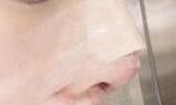 隆鼻案例：术后鼻子变得精致小巧，容颜超精致