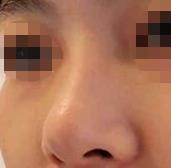隆鼻手术后7-90天恢复过程分享，现在鼻子真的很好看