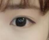 双眼皮手术15-90天恢复分享，眼睛现在又大又有神
