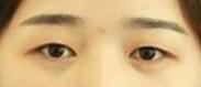 双眼皮手术真实案例分享 术后我也拥有了美丽的眼睛