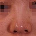 隆鼻修复手术1-90天的情况分享，修复过后鼻子精致多了