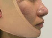 下颌角整形真人手术案例 现在的脸型真的是我所喜欢的类型