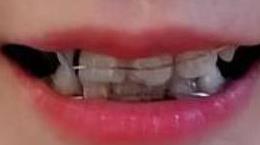 牙齿矫正案例：术后300天摘下矫正器，牙齿变得非常整齐