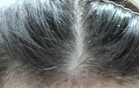 头发种植真实案例 术后真的能长出新头发
