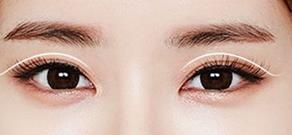 因?yàn)樽隽搜劬χ蠛芏嗳硕伎湮姨貏e漂亮