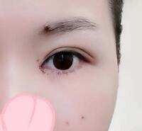 开眼角手术：从术前到术后的蜕变之路