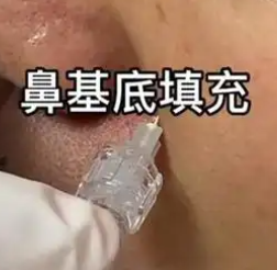 端午煥新顏，玻尿酸助你“粽”享年輕