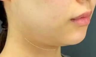 超脂塑面部吸脂手术三个月：整个面部特别的精致瘦小