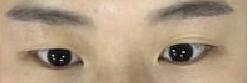 做全切双眼皮真实案例 刘德东口碑很好