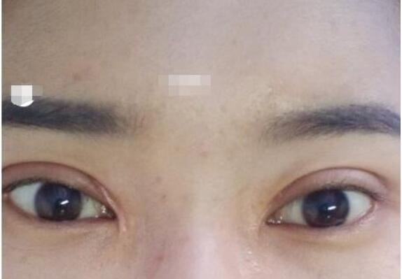 给我做的全切双眼皮+开眼角 我来跟大家分享了