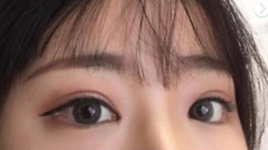 做双眼皮+开眼角真实案例分享